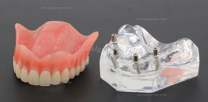 Anatomisches Modell der Zahnz&auml;hne &Uuml;berprothese Superior mit 4 Implantaten Demo Modell 6001